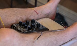 Picture of a patient's legs while they receive electrical stimulation. 